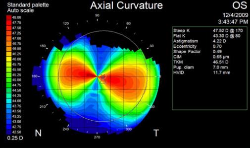Mapa de topografía corneal con la curvatura axial en el astigmatismo