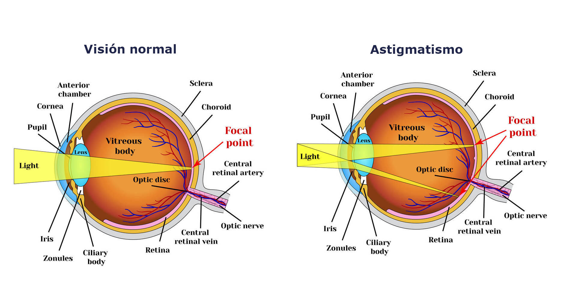 Ejercicios visuales para el astigmatismo