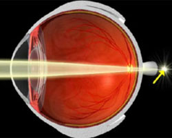 Sección de un ojo hipermétrope que enfoca la luz detrás de la retina