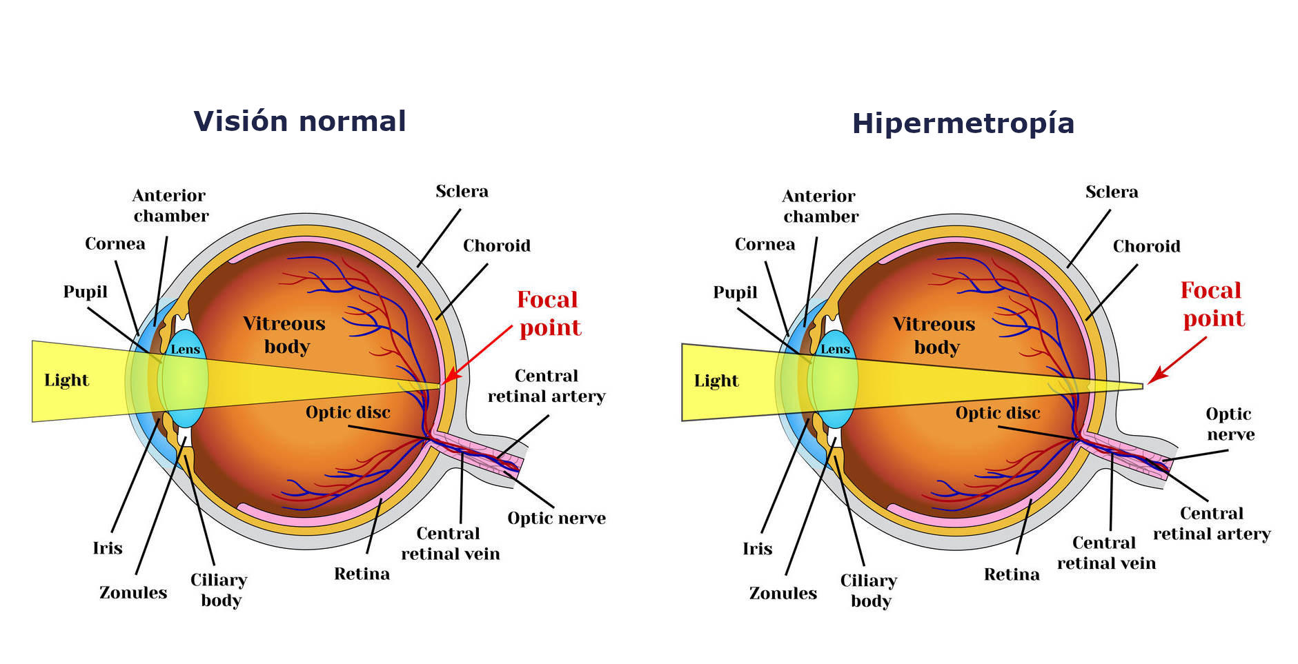 Ejercicios visuales para la hipermetropía
