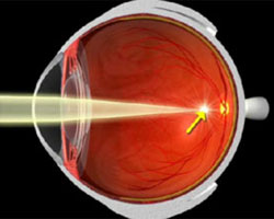 Sección de un ojo miope que enfoca la luz delante de la retina