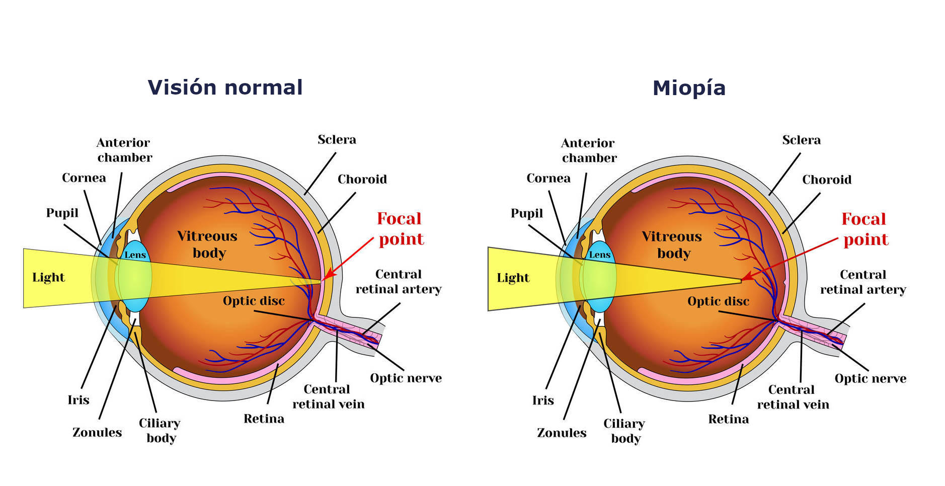 Ejercicios visuales para la miopía